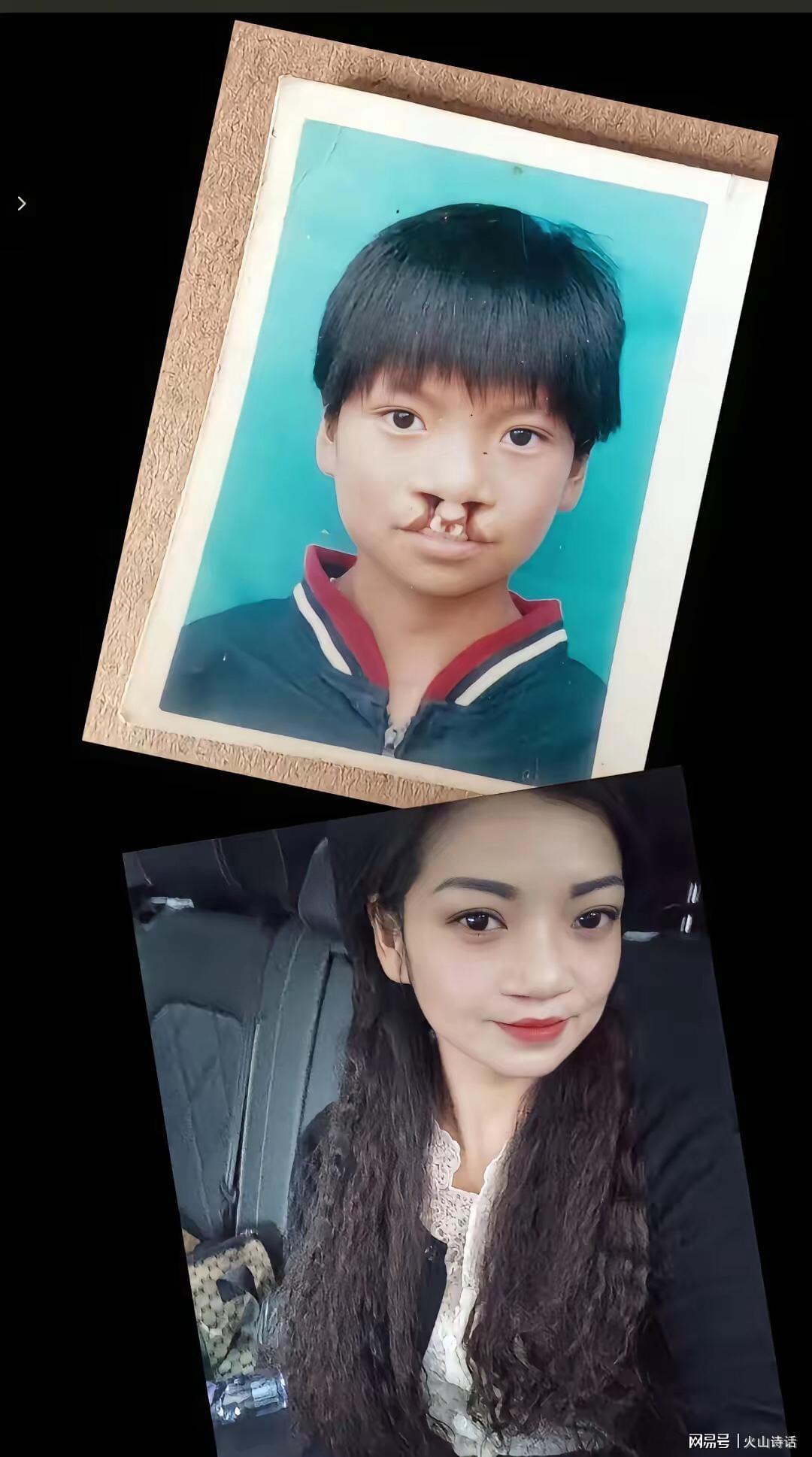 kaiyun应用-震惊！为声援李亚鹏，一漂亮女孩坦然展示自己唇腭裂手术前后照片